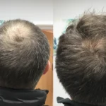 Hair Thinning