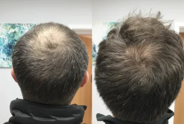 Hair Thinning