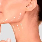 A Non-Surgical Approach to Jawline and Neck Definition