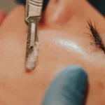 Precision Dermaplaning Treatment