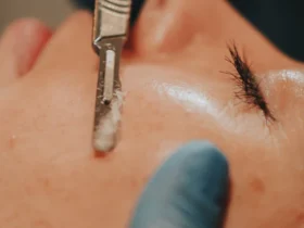 Precision Dermaplaning Treatment
