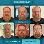 The Real Cost of a Hair Transplant in Turkey in 2026 And Why the Price Gap Is Bigger Than You Think