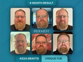 The Real Cost of a Hair Transplant in Turkey in 2026 And Why the Price Gap Is Bigger Than You Think