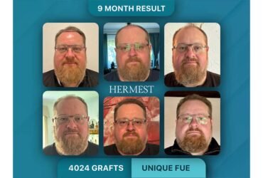 The Real Cost of a Hair Transplant in Turkey in 2026 And Why the Price Gap Is Bigger Than You Think