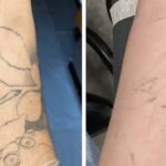 How Skin Tone Affects Tattoo Removal Results