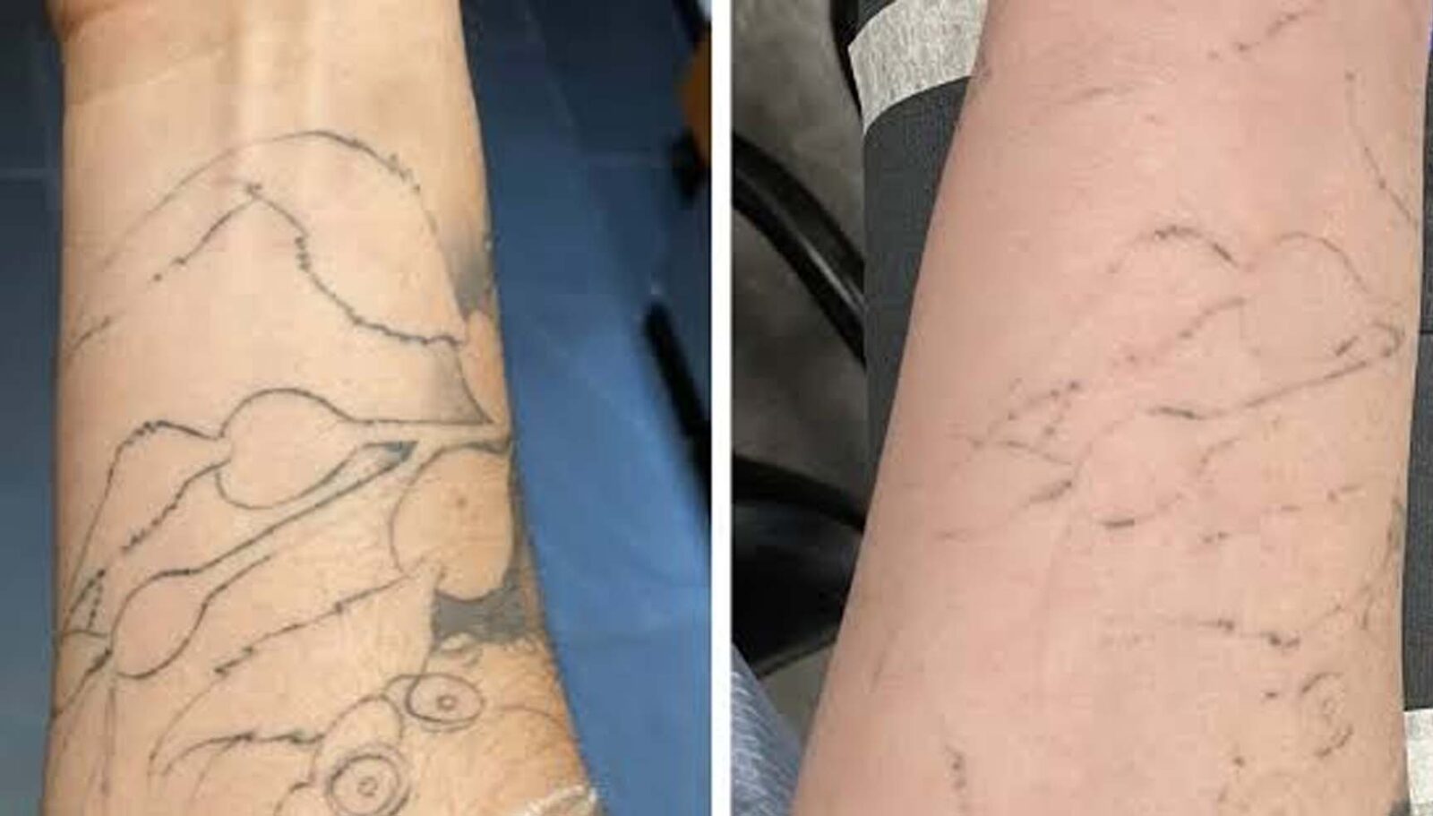How Skin Tone Affects Tattoo Removal Results