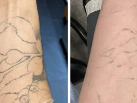 How Skin Tone Affects Tattoo Removal Results
