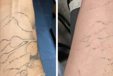 How Skin Tone Affects Tattoo Removal Results