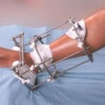 Thigh, Shin or Both: How Your Lengthening Plan Shapes What You Pay in Turkey