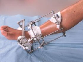 Thigh, Shin or Both: How Your Lengthening Plan Shapes What You Pay in Turkey