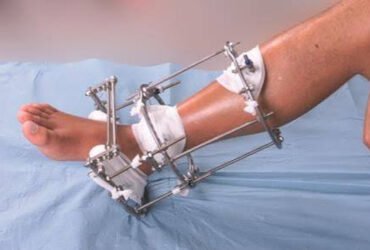 Thigh, Shin or Both: How Your Lengthening Plan Shapes What You Pay in Turkey