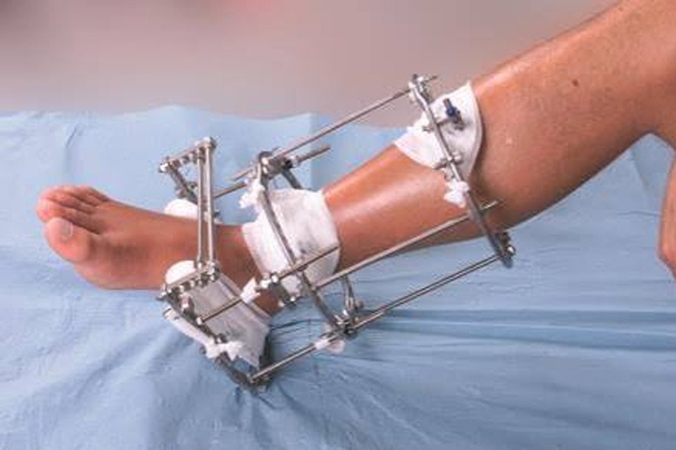 Thigh, Shin or Both: How Your Lengthening Plan Shapes What You Pay in Turkey